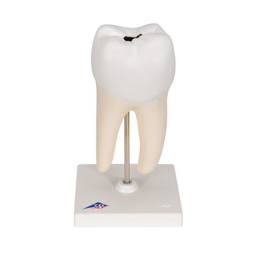Zahn Modell Unterer Zweiwurzeliger Molar mit Karies, 2-teilig - 3B Smart Anatomy