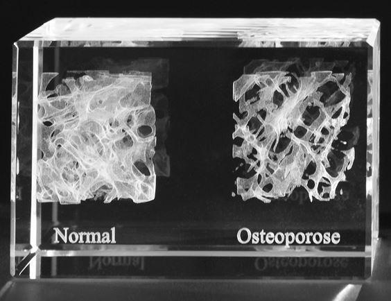 3-D Kristall Motiv: Knochen- Osteoporose im Querschnitt mit Beschriftung  Maße: 80x50x50mm